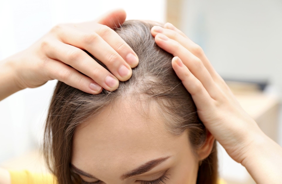 perte cheveux calcaire perte cheveux calcaire